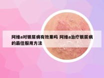 阿维a对银屑病有效果吗 阿维a治疗银屑病的最佳服用方法