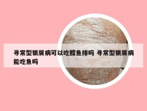 寻常型银屑病可以吃鳕鱼排吗 寻常型银屑病能吃鱼吗