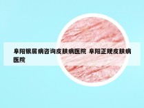 阜阳银屑病咨询皮肤病医院 阜阳正规皮肤病医院