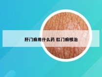 肝门癣用什么药 肛门癣根治