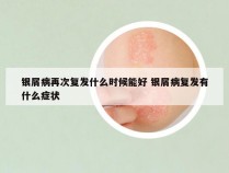 银屑病再次复发什么时候能好 银屑病复发有什么症状
