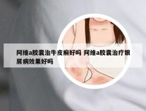 阿维a胶囊治牛皮癣好吗 阿维a胶囊治疗银屑病效果好吗