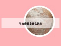 牛皮癣要拿什么洗头