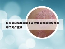 银屑病和硬皮病哪个更严重 银屑病和硬皮病哪个更严重些
