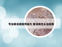 专治银消病祖传秘方 银消病怎么治除根