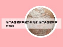 治疗头部银屑病的外用药水 治疗头部银屑病的洗剂