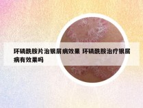 环磷酰胺片治银屑病效果 环磷酰胺治疗银屑病有效果吗