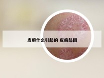 皮癣什么引起的 皮癣起因