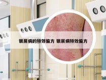 银屑病的特郊偏方 银屑病特效偏方