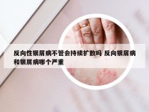 反向性银屑病不管会持续扩散吗 反向银屑病和银屑病哪个严重