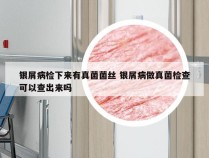 银屑病检下来有真菌菌丝 银屑病做真菌检查可以查出来吗