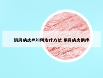 银屑病皮痒如何治疗方法 银屑病皮损痒