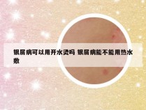 银屑病可以用开水烫吗 银屑病能不能用热水敷