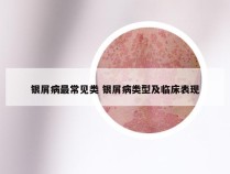 银屑病最常见类 银屑病类型及临床表现
