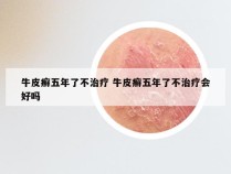 牛皮癣五年了不治疗 牛皮癣五年了不治疗会好吗