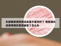 头部银屑病发痒迟皮是不是快好了 银屑病头皮痒得很厉害抓破皮了怎么办