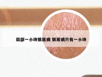 局部一小块银屑病 银屑病只有一小块