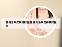 兰州治牛皮癣较好医院 兰州治牛皮癣较好医院