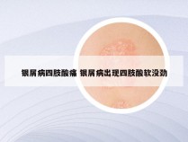 银屑病四肢酸痛 银屑病出现四肢酸软没劲