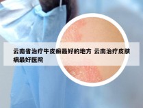 云南省治疗牛皮癣最好的地方 云南治疗皮肤病最好医院