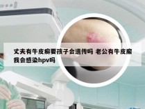 丈夫有牛皮癣要孩子会遗传吗 老公有牛皮廨我会感染hpv吗