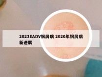 2023EADV银屑病 2020年银屑病新进展