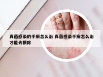 真菌感染的手癣怎么治 真菌感染手癣怎么治才能去根除