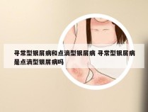 寻常型银屑病和点滴型银屑病 寻常型银屑病是点滴型银屑病吗
