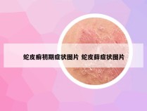 蛇皮癣初期症状图片 蛇皮藓症状图片