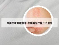 页面牛皮癣啥意思 牛皮癣光疗是什么意思