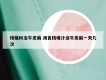 核桃粉治牛皮癣 用青核桃汁涂牛皮癣一天几次