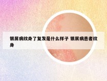 银屑病纹身了复发是什么样子 银屑病患者纹身