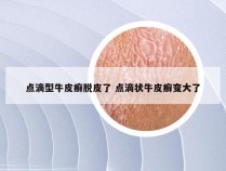 点滴型牛皮癣脱皮了 点滴状牛皮癣变大了