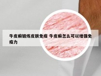 牛皮癣锻炼皮肤免疫 牛皮癣怎么可以增强免疫力