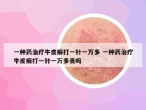 一种药治疗牛皮癣打一针一万多 一种药治疗牛皮癣打一针一万多贵吗