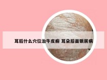 耳后什么穴位治牛皮癣 耳朵后面银屑病