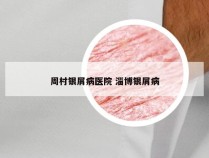 周村银屑病医院 淄博银屑病