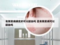 有银屑病病史的可以献血吗 患有银屑病可以献血吗