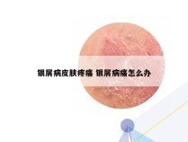 银屑病皮肤疼痛 银屑病痛怎么办