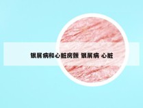 银屑病和心脏房颤 银屑病 心脏