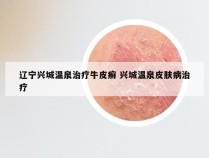 辽宁兴城温泉治疗牛皮癣 兴城温泉皮肤病治疗