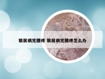 银屑病完腰疼 银屑病完腰疼怎么办