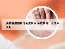 头皮癣应该用什么洗发水 头皮癣用什么洗头膏好