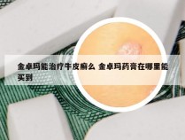 金卓玛能治疗牛皮癣么 金卓玛药膏在哪里能买到