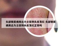 头部银屑病用达力士搽剂头皮发红 头部银屑病用达力士搽剂头皮发红正常吗
