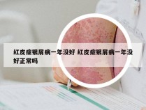 红皮症银屑病一年没好 红皮症银屑病一年没好正常吗