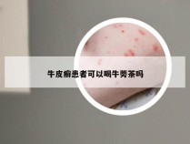 牛皮癣患者可以喝牛蒡茶吗