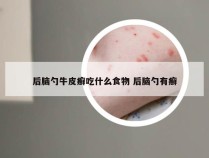 后脑勺牛皮癣吃什么食物 后脑勺有癣