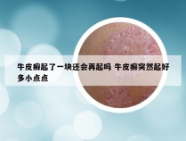 牛皮癣起了一块还会再起吗 牛皮癣突然起好多小点点