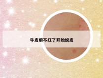 牛皮癣不红了开始蜕皮